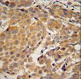 AWAT2 Antibody immunohistochemistry of formalin-fixed and paraffin-embedded human skin carcinoma followed by peroxidase-conjugated secondary antibody and DAB staining.
