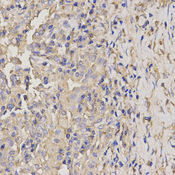 Immunohistochemistry of paraffin-embedded human lung cancer using AXIN2 antibody at dilution of 1:200 (x400 lens).