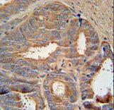 AZGP1 Antibody immunohistochemistry of formalin-fixed and paraffin-embedded human prostate carcinoma followed by peroxidase-conjugated secondary antibody and DAB staining.