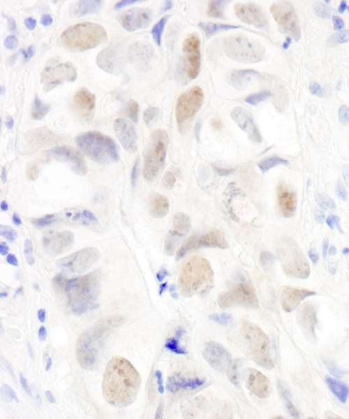 Detection of Human Anillin by Immunohistochemistry. Sample: FFPE section of human colon carcinoma. Antibody: Affinity purified rabbit anti-Anillin used at a dilution of 1:1000 (1 ug/ml).