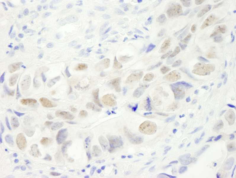 Detection of Human Anillin by Immunohistochemistry. Sample: FFPE section of human colon carcinoma. Antibody: Affinity purified rabbit anti-Anillin used at a dilution of 1:250.
