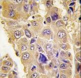 Formalin-fixed and paraffin-embedded human hepatocarcinoma tissue reacted with Autophagy APG7L antibody , which was peroxidase-conjugated to the secondary antibody, followed by DAB staining. This data demonstrates the use of this antibody for immunohistochemistry; clinical relevance has not been evaluated.