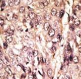 Formalin-fixed and paraffin-embedded human cancer tissue reacted with the primary antibody, which was peroxidase-conjugated to the secondary antibody, followed by AEC staining. This data demonstrates the use of this antibody for immunohistochemistry; clinical relevance has not been evaluated. BC = breast carcinoma; HC = hepatocarcinoma.