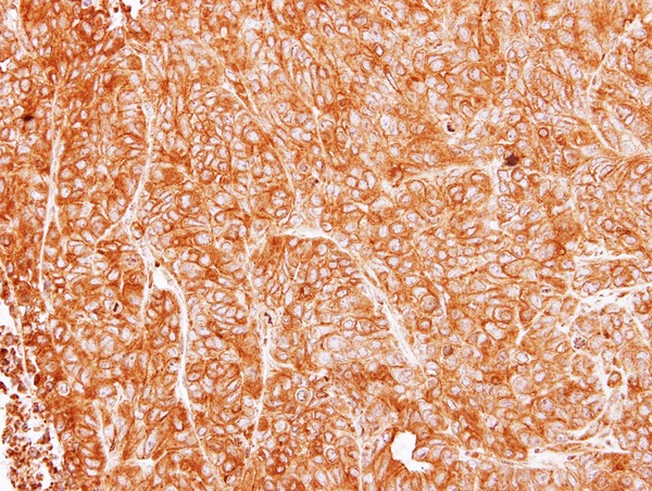 IHC of paraffin-embedded DLD1 xenograft using ASL antibody at 1:500 dilution.