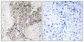 IHC of paraffin-embedded human liver carcinoma tissue, using B3GALTL Antibody. The picture on the right is treated with the synthesized peptide.