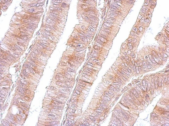 B3GNT3 antibody detects B3GNT3 protein at cytosol on colon by immunohistochemical analysis. Sample: Paraffin-embedded colon. B3GNT3 antibody dilution:1:500.