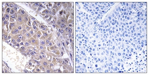 IHC of paraffin-embedded human liver carcinoma tissue, using B4GALT3 Antibody. The picture on the right is treated with the synthesized peptide.