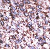 Formalin-fixed and paraffin-embedded human cancer tissue reacted with the primary antibody, which was peroxidase-conjugated to the secondary antibody, followed by AEC staining. This data demonstrates the use of this antibody for immunohistochemistry; clinical relevance has not been evaluated. BC = breast carcinoma; HC = hepatocarcinoma.