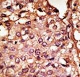 Formalin-fixed and paraffin-embedded human cancer tissue reacted with the primary antibody, which was peroxidase-conjugated to the secondary antibody, followed by AEC staining. This data demonstrates the use of this antibody for immunohistochemistry; clinical relevance has not been evaluated. BC = breast carcinoma; HC = hepatocarcinoma.