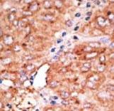 Formalin-fixed and paraffin-embedded human cancer tissue reacted with the primary antibody, which was peroxidase-conjugated to the secondary antibody, followed by AEC staining. This data demonstrates the use of this antibody for immunohistochemistry; clinical relevance has not been evaluated. BC = breast carcinoma; HC = hepatocarcinoma.