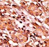 Formalin-fixed and paraffin-embedded human cancer tissue reacted with the primary antibody, which was peroxidase-conjugated to the secondary antibody, followed by AEC staining. This data demonstrates the use of this antibody for immunohistochemistry; clinical relevance has not been evaluated. BC = breast carcinoma; HC = hepatocarcinoma.