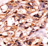 Formalin-fixed and paraffin-embedded human cancer tissue reacted with the primary antibody, which was peroxidase-conjugated to the secondary antibody, followed by AEC staining. This data demonstrates the use of this antibody for immunohistochemistry; clinical relevance has not been evaluated. BC = breast carcinoma; HC = hepatocarcinoma.