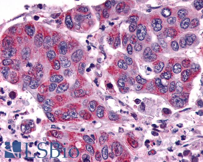 Anti-ACKR3 / CXCR7 / RDC1 antibody IHC of human Colon, Carcinoma. Immunohistochemistry of formalin-fixed, paraffin-embedded tissue after heat-induced antigen retrieval.