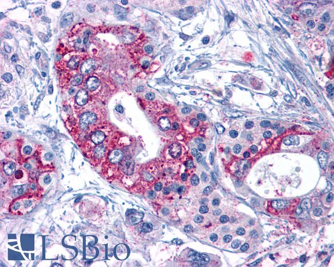 Anti-ACKR3 / CXCR7 / RDC1 antibody IHC of human Pancreas, Carcinoma. Immunohistochemistry of formalin-fixed, paraffin-embedded tissue after heat-induced antigen retrieval.