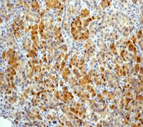 IHC of paraffin-embedded human ovarian carcinoma tissue using anti-BAG2 antibody (LS-C105560).
