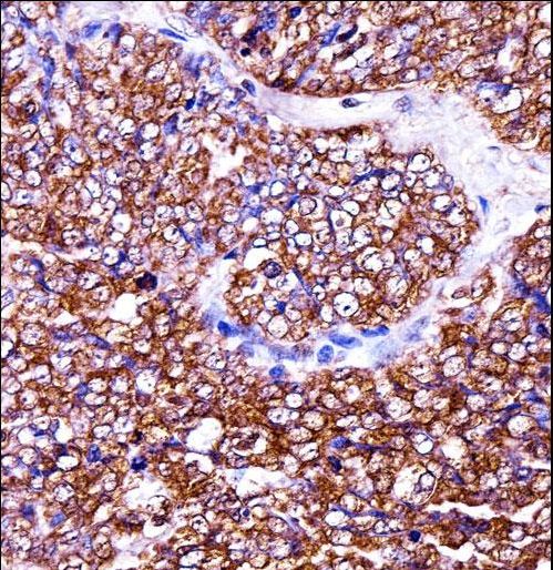BAG2 Antibody immunohistochemistry of formalin-fixed and paraffin-embedded human ovarian carcinoma followed by peroxidase-conjugated secondary antibody and DAB staining.