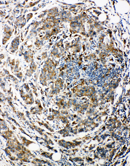 BAG3 / BAG-3 antibody. IHC(P): Human Breast Cancer Tissue.