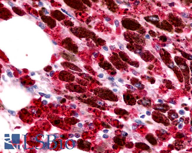 Anti-ACKR4 / CCRL1 / CCR11 antibody IHC of human Skin, Melanoma. Immunohistochemistry of formalin-fixed, paraffin-embedded tissue after heat-induced antigen retrieval.