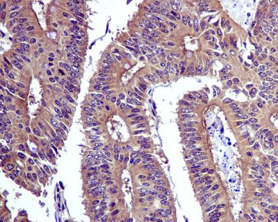IHC of paraffin-embedded human colonic adenocarcinoma tissue using anti-SODD antibody.