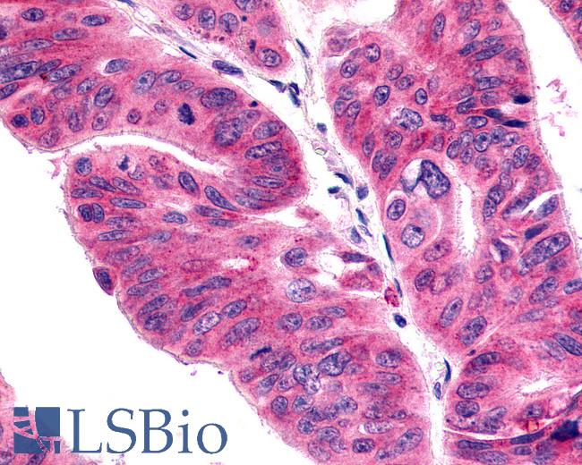 Anti-ACKR4 / CCRL1 / CCR11 antibody IHC of human Colon, Carcinoma. Immunohistochemistry of formalin-fixed, paraffin-embedded tissue after heat-induced antigen retrieval.