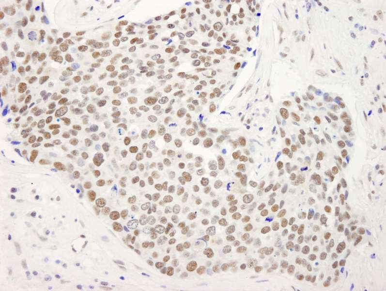 Detection of Human SMAR1/BANP by Immunohistochemistry. Sample: FFPE section of human breast tumor. Antibody: Affinity purified rabbit anti-SMAR1/BANP used at a dilution of 1:250.