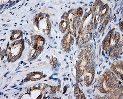 IHC of paraffin-embedded Carcinoma of prostate tissue using anti-SIL1 mouse monoclonal antibody. (Dilution 1:50).