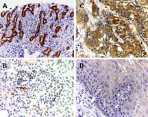 Formalin-fixed, paraffin-embedded sections of tumor and normal human tissues stained for BAR expression using LS-C148223 at 1:2000. A. Pancreatic cancer. B. Normal pancreas. C. Esophageal cancer. D. Normal esophagus. Increased expression of BAR was detected in the tumor, compared to normal tissues. Hematoxylin-Eosin counterstain.
