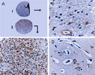 Formalin-fixed, paraffin-embedded tissue sections stained for BAR expression using LS-C148222 at 1:2000. A. Two cores from a human glioblastoma tissue microarray: 1 =fibrillary astrocytoma (grade I), and2 = anaplastic glioma (grade III). B. Higher magnification from the fibrillary astrocytoma (shown in A). C. Higher magnification from the anaplastic glioma (shown in A). D. Normal human brain striatum with positive medium spiny neurons, the major neuronal cell type of the striatum. Hematoxylin-Eos in counterstain.
