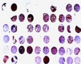 Formalin-fixed, paraffin-embedded human prostate carcinoma tissue array stained for BAR expression using LS-C148222 at 1:2000. Hematoxylin-Eosin counterstain. Variable BAR expression is seen between patient samples.
