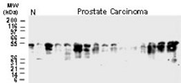 Western blot of BAR in normal prostate and prostate carcinoma tissue lysates. 25 ug protein was loaded per lane. Tissue lysates from 15 different prostate carcinoma patients show variable expression of BAR with respect to banding patterns and amount of BAR expression. Major BAR bands typically migrate as a single band or as a doublet. These bands are typically observed at ~50-54 kD. This is higher than the predicted molecular weight from the 450 amino acid BAR sequence, and may represent phosphorylation or other post-translational modifications. N = tissue lysate from normal prostate.