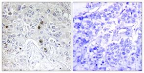 IHC of paraffin-embedded human breast carcinoma tissue, using BATF Antibody. The picture on the right is treated with the synthesized peptide.