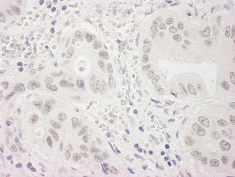 Detection of Human WSTF by Immunohistochemistry. Sample: FFPE section of human non-small cell lung cancer. Antibody: Affinity purified rabbit anti-WSTF used at a dilution of 1:250.