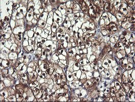 IHC of paraffin-embedded Carcinoma of Human kidney tissue using anti-BBOX1 mouse monoclonal antibody.