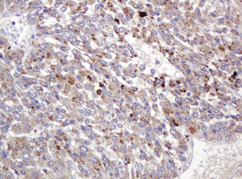 IHC of paraffin-embedded Carcinoma of Human liver tissue using anti-BBOX1 mouse monoclonal antibody. (Heat-induced epitope retrieval by 10mM citric buffer, pH6.0, 120°C for 3min).