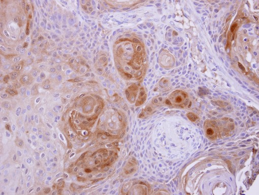 BBOX1 antibody detects BBOX1 protein at cytosol on Ca922 xenograft by immunohistochemical analysis. Sample: Paraffin-embedded Ca922 xenograft. BBOX1 antibody dilution:1:500.