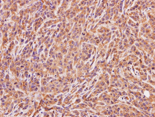 IHC of paraffin-embedded SAS xenograft using ACMSD antibody at 1:100 dilution.