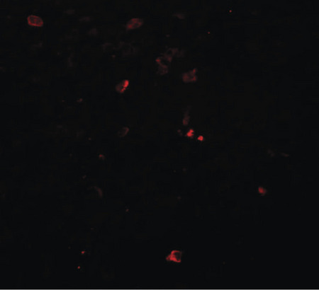 Immunofluorescence of BCAS3 in human breast carcinoma tissue with BCAS3 antibody at 20 ug/ml.
