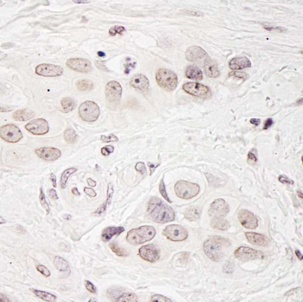 Detection of Human BCAS3 by Immunohistochemistry. Sample: FFPE section of human breast carcinoma. Antibody: Affinity purified rabbit anti-BCAS3 used at a dilution of 1:200 (1 ug/ml).