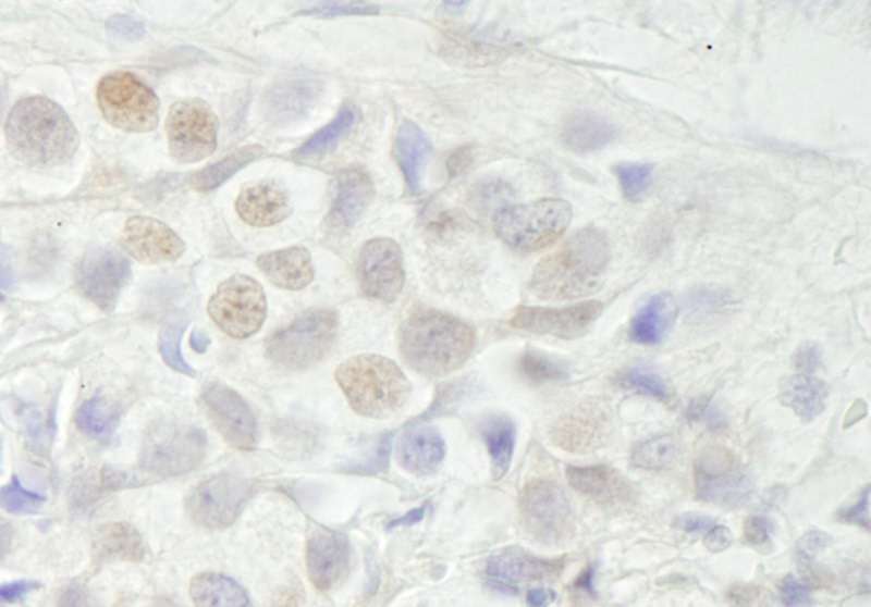 Detection of Human BCAS3 by Immunohistochemistry. Sample: FFPE section of human breast carcinoma. Antibody: Affinity purified rabbit anti-BCAS3 used at a dilution of 1:500.