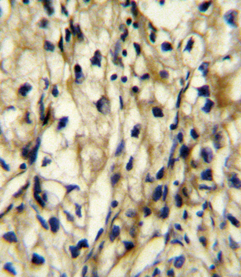 BCAT1 Antibody immunohistochemistry of formalin-fixed and paraffin-embedded human kidney carcinoma followed by peroxidase-conjugated secondary antibody and DAB staining.