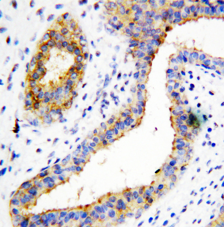 BCAT1 / ECA39 antibody. IHC(P): Human Breast Cancer Tissue.
