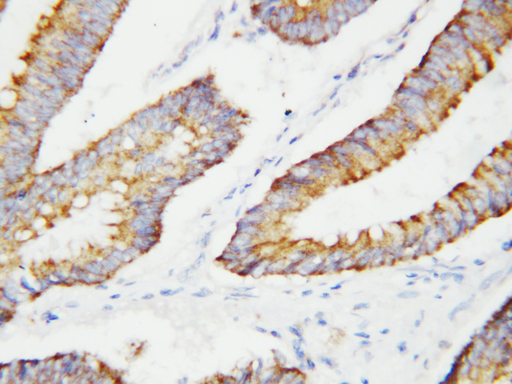 BCAT2 antibody. IHC(P): Human Colon Cancer Tissue.