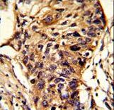 Formalin-fixed and paraffin-embedded human lung carcinoma reacted with BCKDHA Antibody , which was peroxidase-conjugated to the secondary antibody, followed by DAB staining. This data demonstrates the use of this antibody for immunohistochemistry; clinical relevance has not been evaluated.