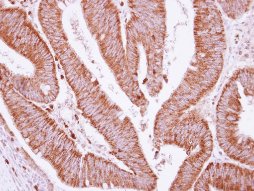 IHC of paraffin-embedded Colon ca, using BCKDHA antibody at 1:250 dilution.
