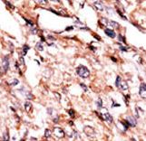 Formalin-fixed and paraffin-embedded human cancer tissue reacted with the primary antibody, which was peroxidase-conjugated to the secondary antibody, followed by AEC staining. This data demonstrates the use of this antibody for immunohistochemistry; clinical relevance has not been evaluated. BC = breast carcinoma; HC = hepatocarcinoma.