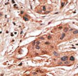 Formalin-fixed and paraffin-embedded human cancer tissue reacted with the primary antibody, which was peroxidase-conjugated to the secondary antibody, followed by DAB staining. This data demonstrates the use of this antibody for immunohistochemistry; clinical relevance has not been evaluated. BC = breast carcinoma; HC = hepatocarcinoma.