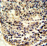 Formalin-fixed and paraffin-embedded human lung carcinoma reacted with BCL2A1 Antibody , which was peroxidase-conjugated to the secondary antibody, followed by DAB staining. This data demonstrates the use of this antibody for immunohistochemistry; clinical relevance has not been evaluated.