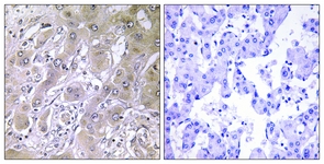 IHC of paraffin-embedded human liver carcinoma tissue, using ACOT12 Antibody. The picture on the right is treated with the synthesized peptide.