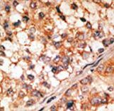 Formalin-fixed and paraffin-embedded human cancer tissue reacted with the primary antibody, which was peroxidase-conjugated to the secondary antibody, followed by DAB staining. This data demonstrates the use of this antibody for immunohistochemistry; clinical relevance has not been evaluated. BC = breast carcinoma; HC = hepatocarcinoma.