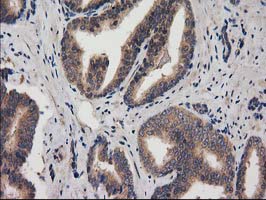IHC of paraffin-embedded Carcinoma of Human prostate tissue using anti-ACOT12 mouse monoclonal antibody.
